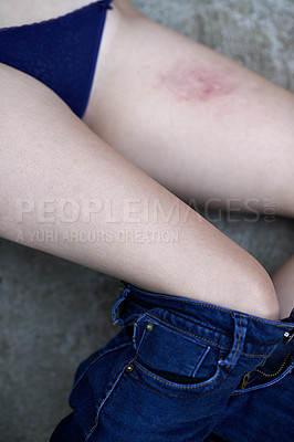Buy stock photo Cropped shot of a woman's bruised legs with her jeans pulled down