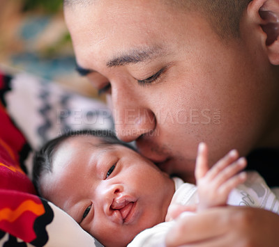 Buy stock photo Shot of a young father giving his baby girl who has a cleft palate a kiss on the cheek