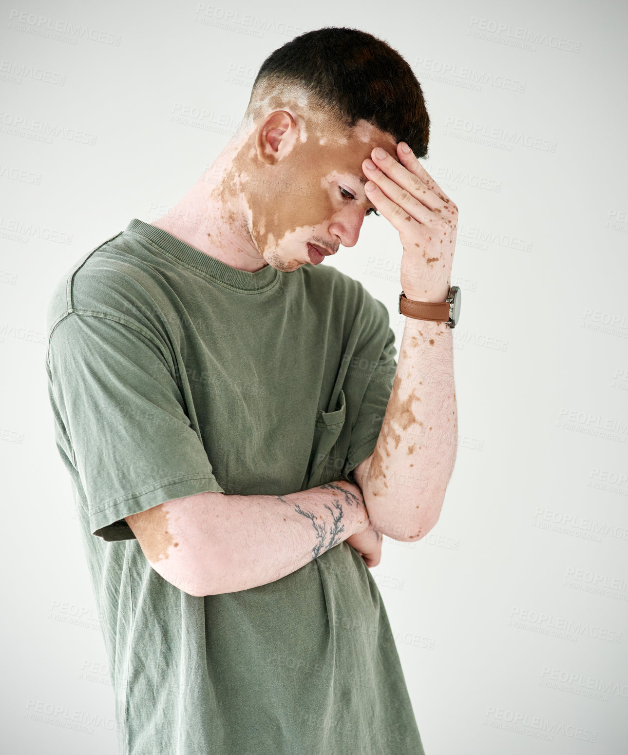 Buy stock photo Studio shot of a young man with vitiligo looking upset against a white background