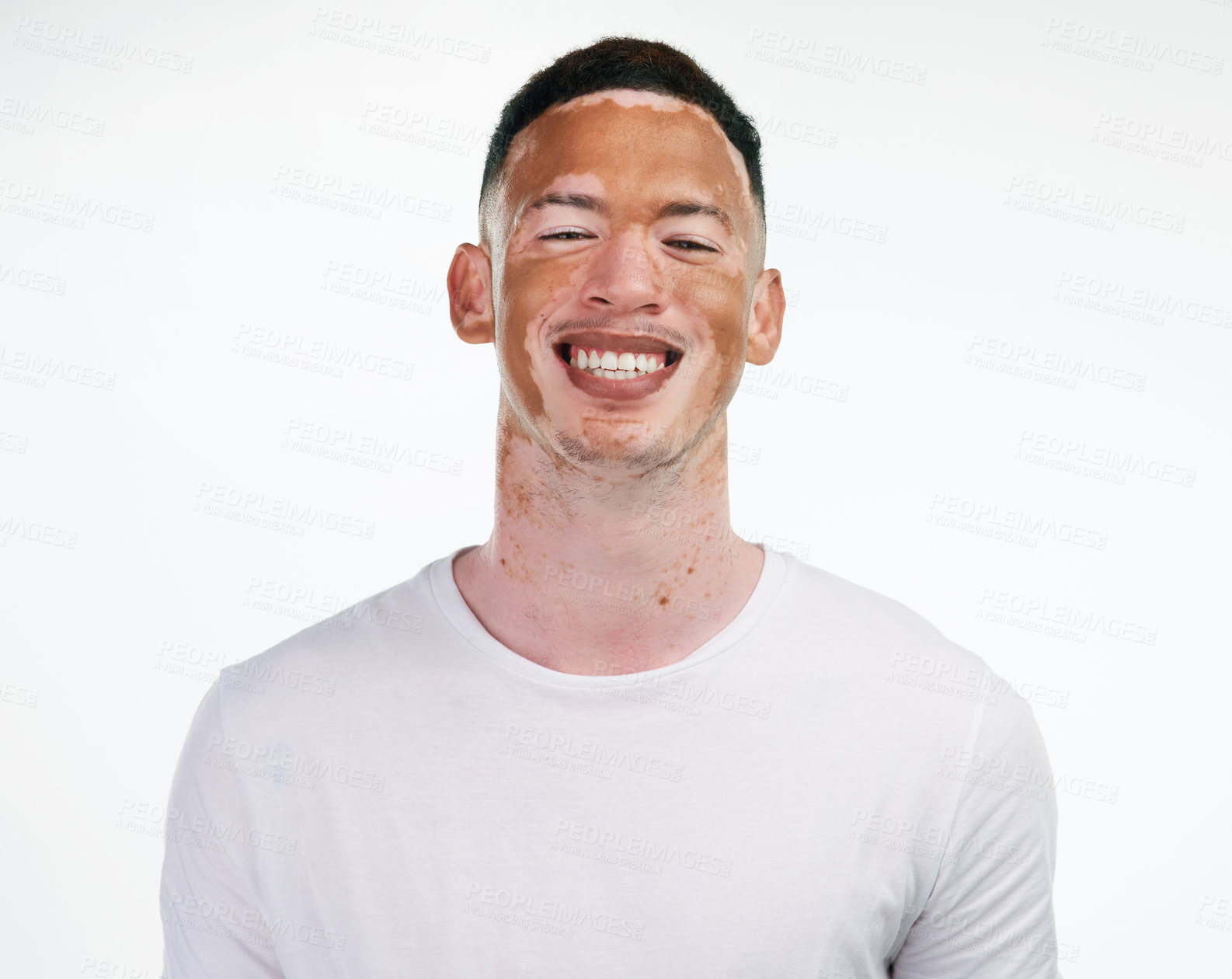 Buy stock photo Portrait shot of a handsome young man with vitiligo posing on a white background