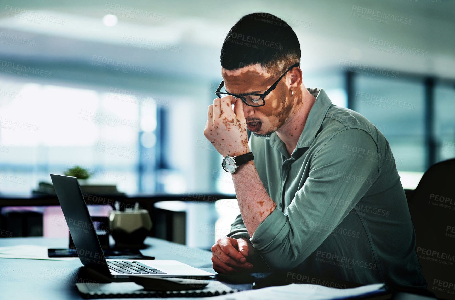 Buy stock photo Eye strain, glasses or man in office with laptop, headache or brain fog in task management. Screen fatigue, tech or employee in agency with vitiligo, migraine or vision discomfort in deadline issue.