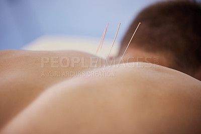 Buy stock photo Acupuncture, needles and healing treatment of body in healthcare wirth back pain, injury or relief in muscle. Clinic, patient and physiotherapy dry needling to relax and holistic care for injury