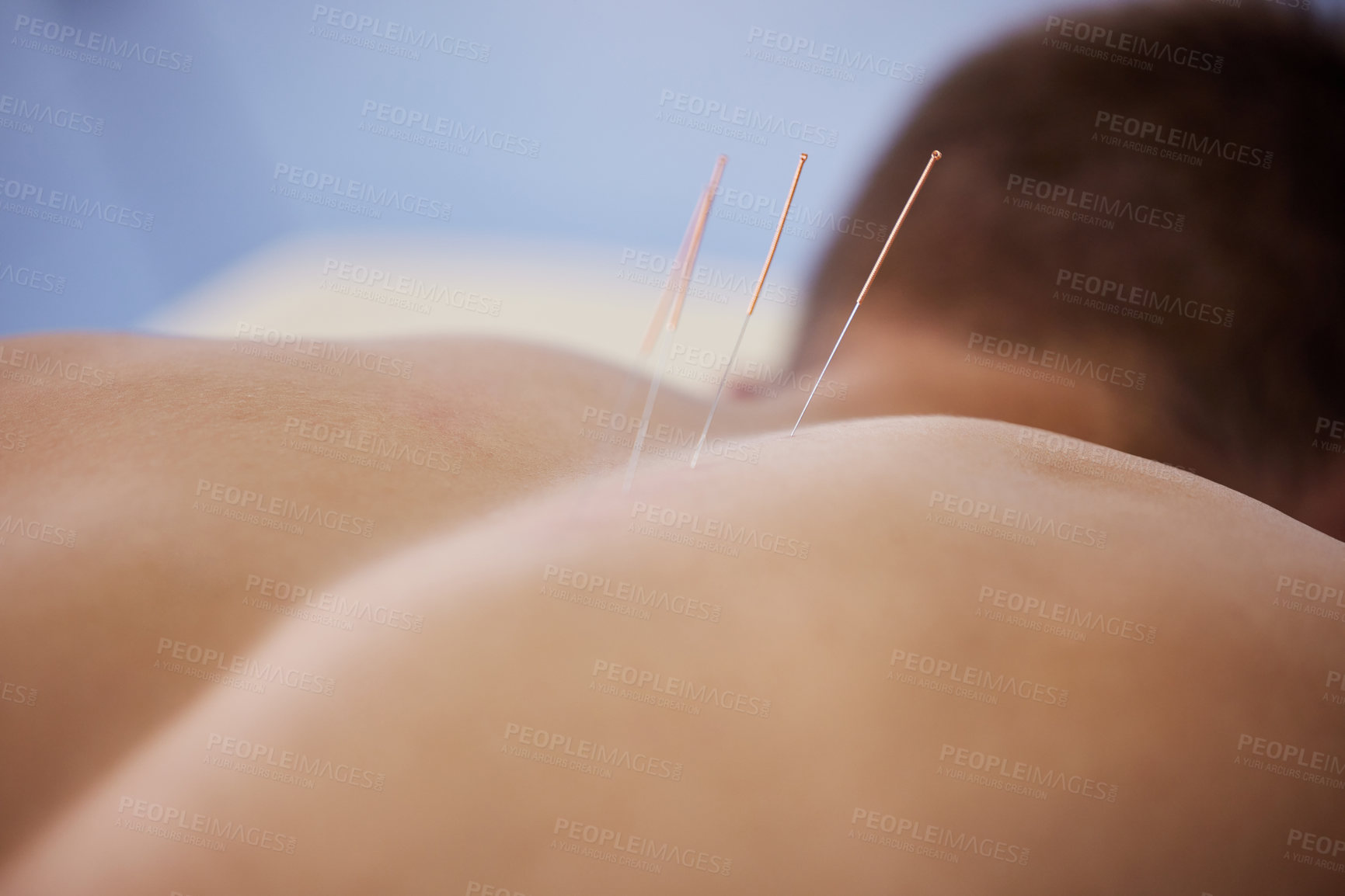 Buy stock photo Acupuncture, needles and healing treatment of body in healthcare wirth back pain, injury or relief in muscle. Clinic, patient and physiotherapy dry needling to relax and holistic care for medicine