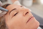 Micro needling radically enhances the skin's texture