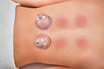 Cupping, therapy and spa with a woman customer lying on a massage table in a beauty center from above. Relax, luxury or wellness with the back of a female in a health center for suction cup treatment