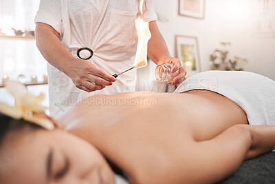 Buy stock photo Relax, luxury and woman in cupping therapy for back pain or muscle injury sleeping in peace for physiotherapy. Fire, heating and girl customer with physiotherapist in physical therapy for healing