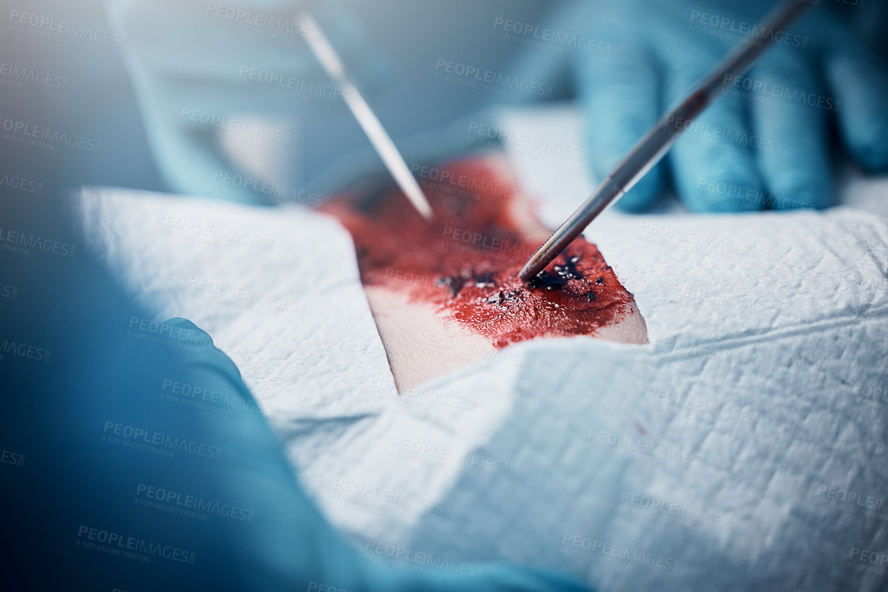 Buy stock photo Doctors, nurses or surgery hands on cut patient in hospital emergency room for stomach ulcer, heart attack or burst appendix. Blood, healthcare workers or surgical operation and steel metal equipment