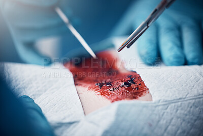 Buy stock photo Doctors, nurses or surgery hands on cut patient in hospital emergency room for stomach ulcer, heart attack or burst appendix. Blood, healthcare workers or surgical operation and steel metal equipment