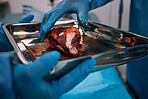 Hospital, doctor and organ transplant surgery in operating room with hands, healthcare and medical emergency. Blood, doctors hand and closeup of donor operation for healthy organs and surgeon at work