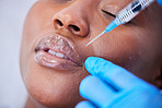 Plastic surgery, needle and black woman with lip filler closeup on a hospital bed with dermatology. Surgeon, facial change and for skincare, cosmetics and wellness in a clinic with doctor hand