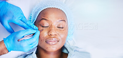 Buy stock photo Plastic surgery, pen and black woman sleep on a hospital bed with dermatology with mockup space. Surgeon, facial change and medical filler for skincare, cosmetics and wellness in a clinic with doctor