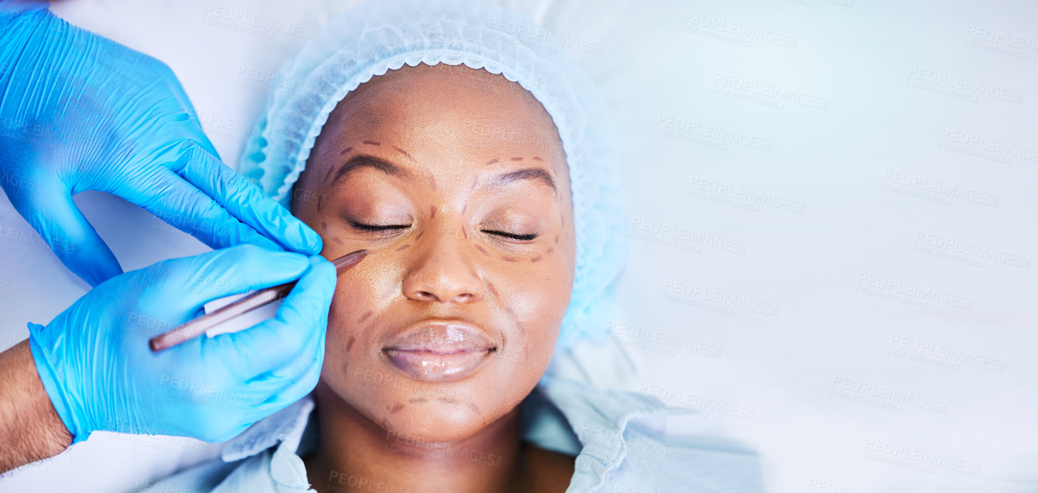 Buy stock photo Plastic surgery, pen and black woman sleep on a hospital bed with dermatology with mockup space. Surgeon, facial change and medical filler for skincare, cosmetics and wellness in a clinic with doctor