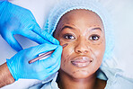 Plastic surgery, pen and black woman portrait on a hospital bed with dermatology with face mark. Surgeon, facial change and medical filler for skincare, cosmetics and wellness in clinic with doctor