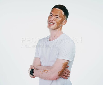 Buy stock photo Portrait shot of a handsome young man with vitiligo posing with his arms folded on a white background