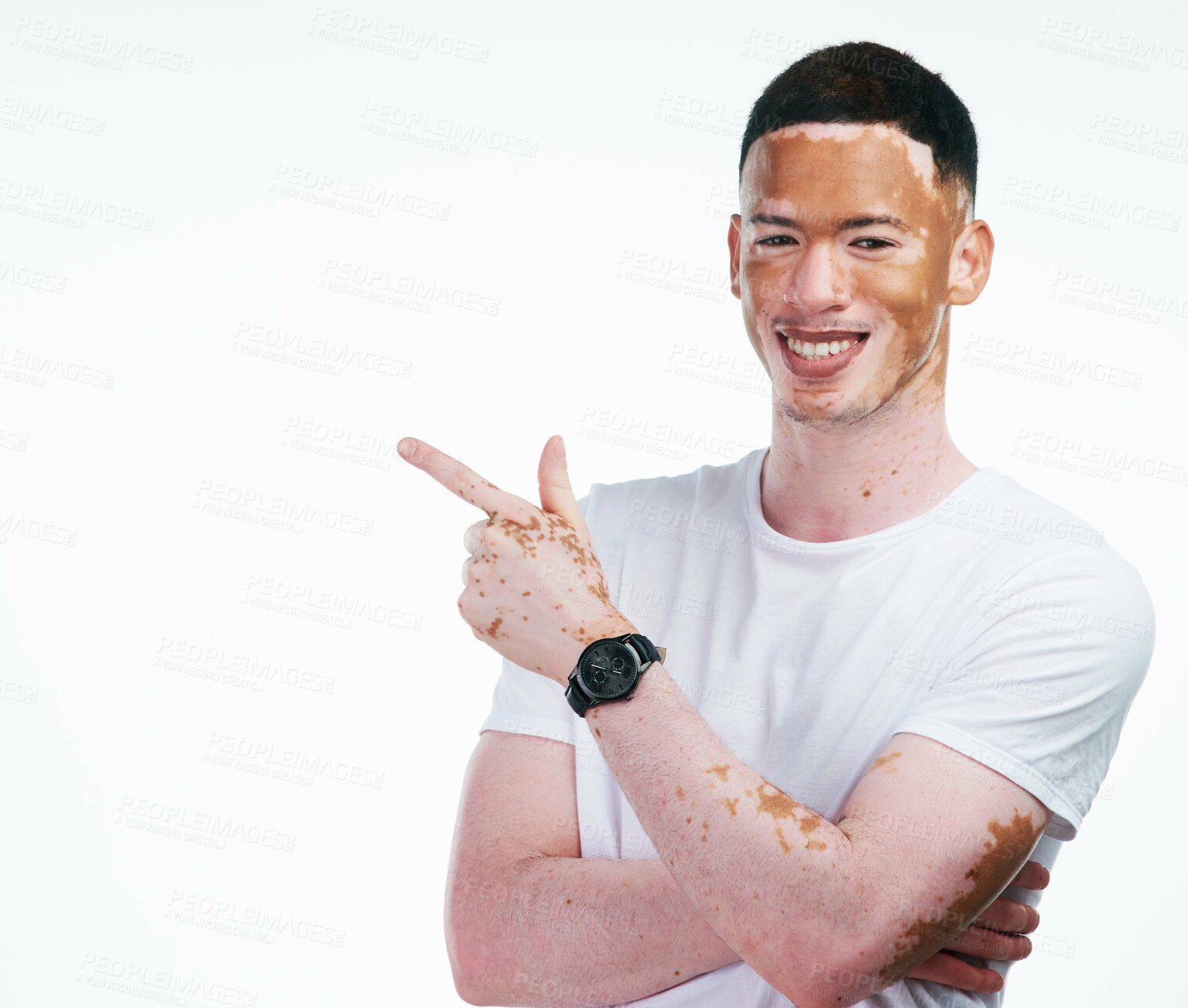 Buy stock photo Portrait shot of a handsome young man with vitiligo posing on a white background