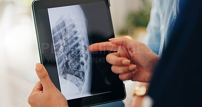 Buy stock photo Healthcare, x ray and tablet for hand in closeup by pointing of injury on screen in consulting. Medical professional, doctor or person for technology of results, diagnosis or bone fracture of patient