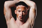 Skincare, beauty and portrait of man with vitiligo on black background for wellness, dermatology and body care. Fashion, cosmetics and face of male with natural, healthy and glowing skin in studio
