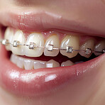 Person, teeth and braces closeup as dentistry smile or straight alignment, whitening or health insurance. Mouth, tooth and orthodontic cases for oral care results or treatment, examination or hygiene