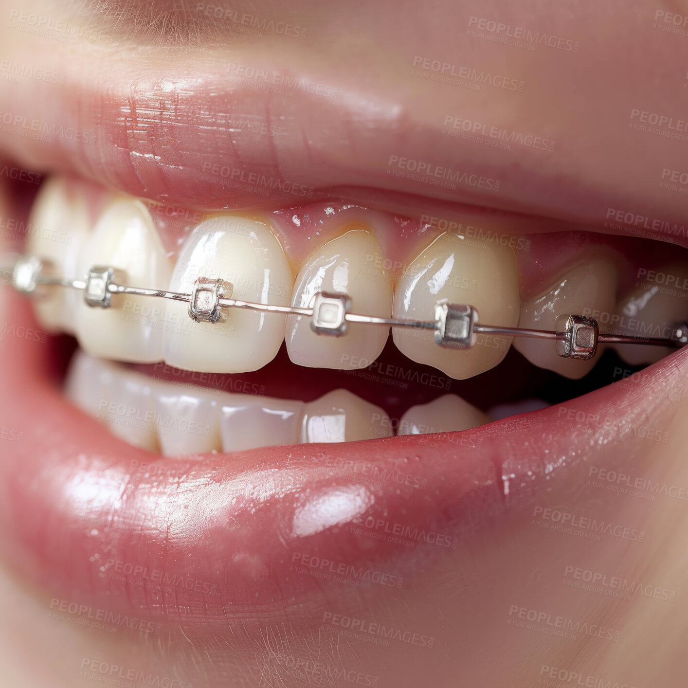 Buy stock photo Person, teeth and braces closeup as dentistry smile or straight alignment, whitening or health insurance. Mouth, tooth and orthodontic cases for oral care results or treatment, examination or hygiene