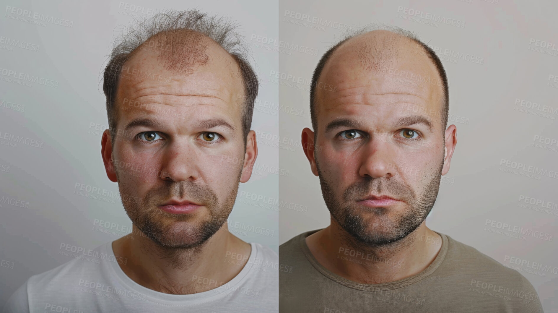 Buy stock photo Hair loss, portrait and man with before and after for results of stress, cancer or depression in men. Bald, cosmetics and skin by scalp with alopecia for hairline transplant, plastic surgery and prp