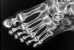 Xray, anatomy and foot skeleton on film, human body and assessment for radiology examination. Joints, electromagnetic radiation and bone image or internal structure, polydactyly abnormality or defect