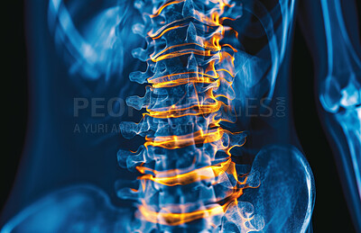 Spine, inflammation and back pain or x ray healthcare with vertebra pressure, tension or overlay. Life insurance, anatomy herniated disc with skeleton bone or diagnosis surgery, fracture or scoliosis
