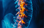 Spine, inflammation and back pain as nerve healthcare or vertebra pressure, tension or overlay. X ray, life insurance and herniated disc with skeleton bone or diagnosis surgery, fracture or scoliosis