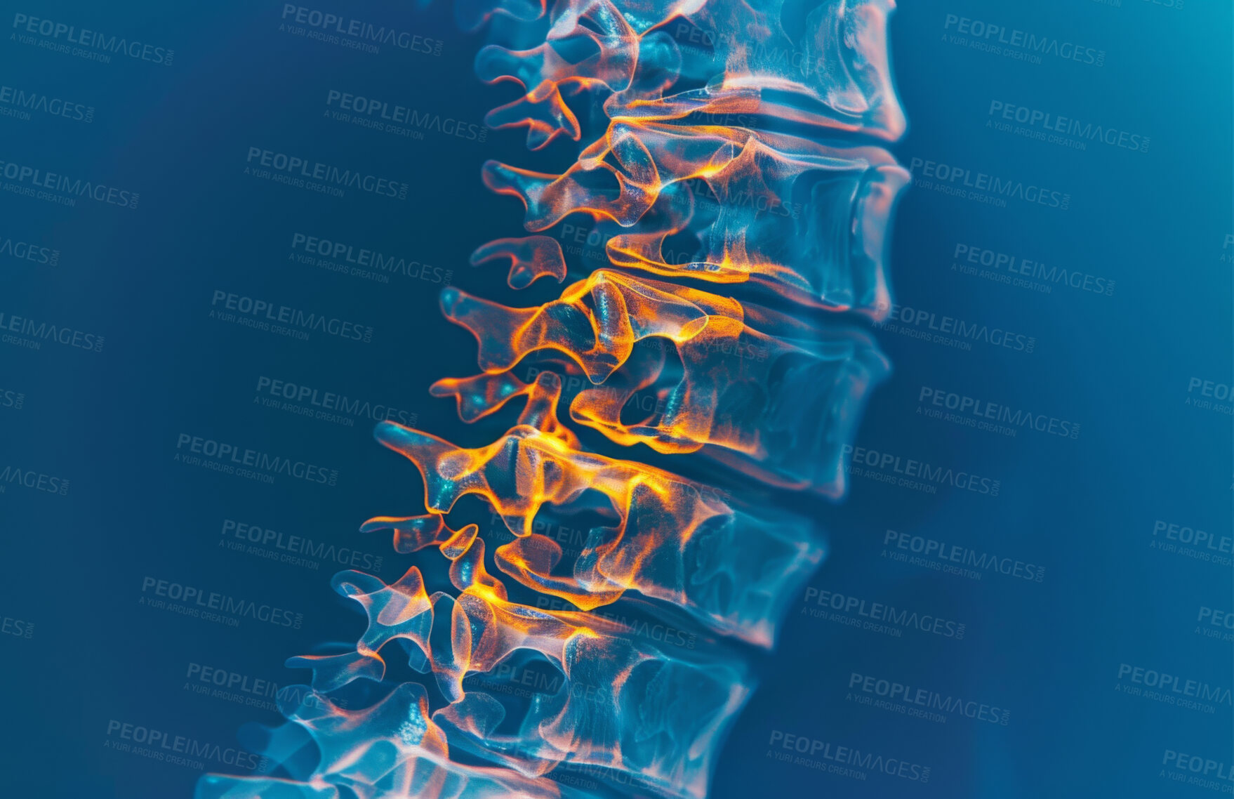 Buy stock photo Inflammation, spine and 3D in xray for medicare, healthcare or radiology at hospital or clinic. Injury, bone and nerve for medical, research and diagnosis of patient as results in scan for scoliosis