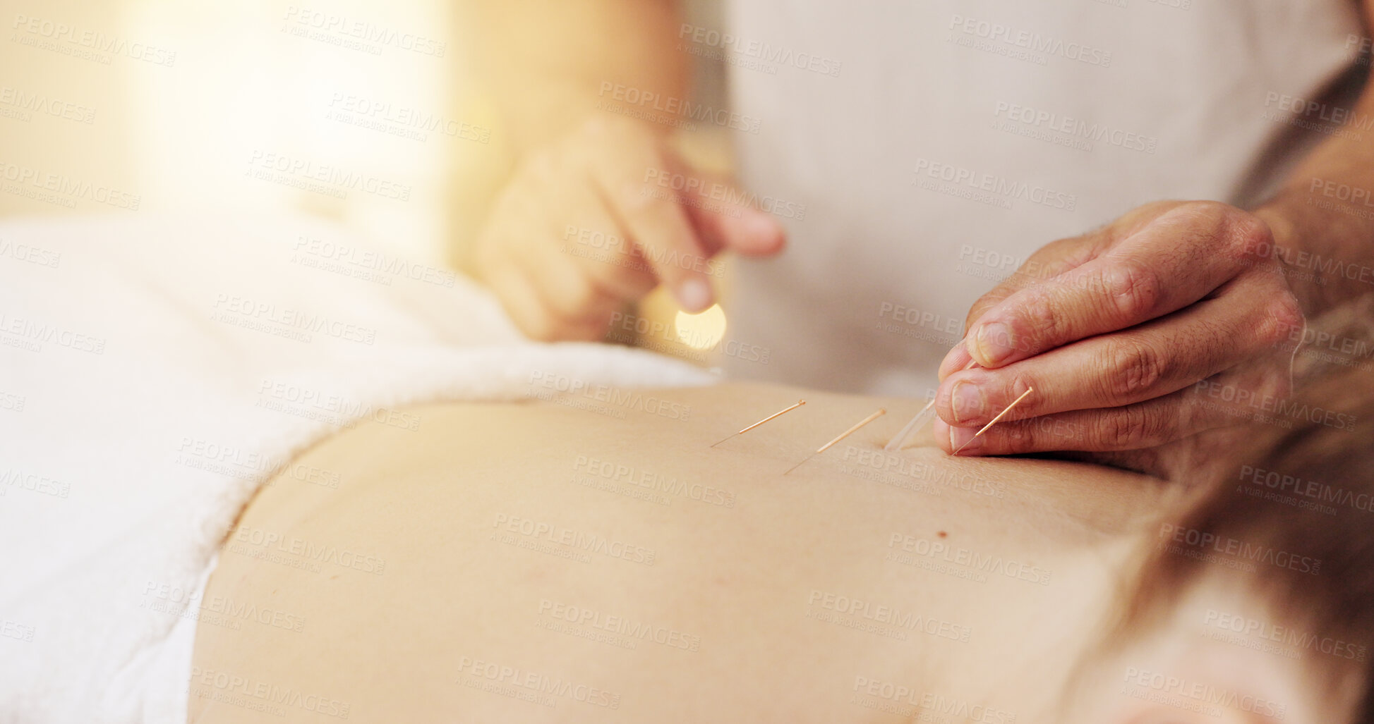 Buy stock photo Acupuncture, hands and stress relief in spa with customer for healing, holistic therapy or to relax. Body, dry needling and treatment with masseuse in resort for cosmetics, massage and skincare