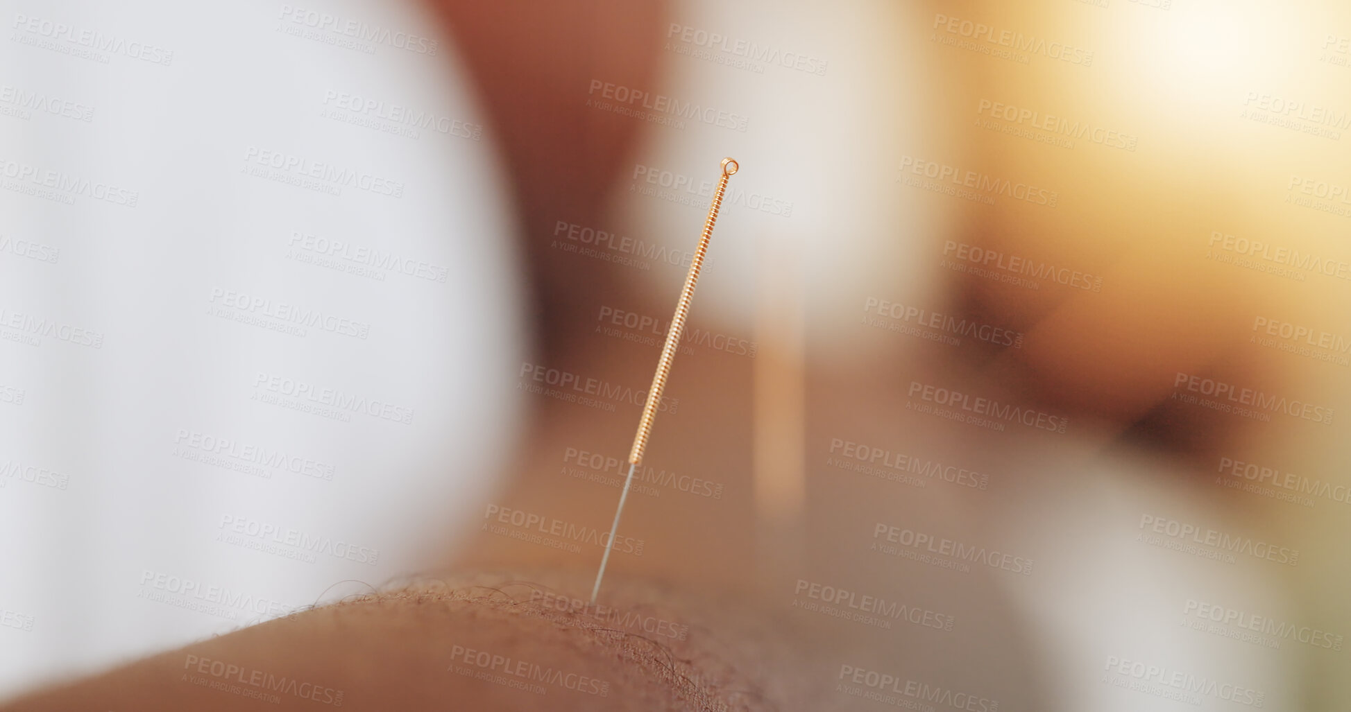 Buy stock photo Acupuncture, needles and skin for wellness in clinic, alternative medicine or healing therapy. Relax, muscle and body pain in spa for health or stress treatment, support for immune system or injury