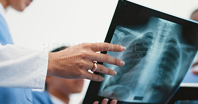 Buy stock photo Nurse, hands and x ray analysis in hospital, professional consultation and teamwork collaboration for medical results. Radiology, film and examine respiratory system, diagnosis and people discussion