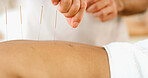 Hands, back and acupuncture in spa with needle for injury relief, wellness or traditional medicine. Worker, person and body care at resort with pin for pain management, ancient treatment and healing.