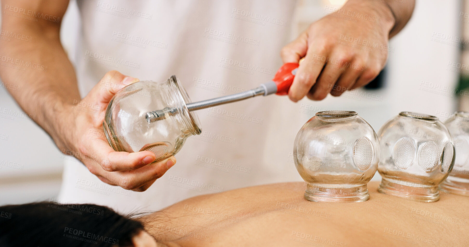 Buy stock photo Hands, lighter and cupping therapy for back pain, relax and healing for muscle blood flow benefits. Therapist, holistic spa and person on bed for wellness, health or resort with deep tissue massage