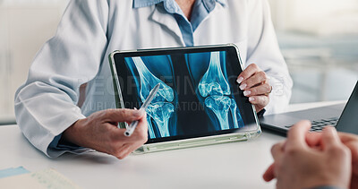 Buy stock photo Tablet screen, consulting and doctor hands with xray for knee injury, diagnostic results or help. Patient, woman or tech with CT scan review for joint damage, bone marrow transplant or clinic checkup