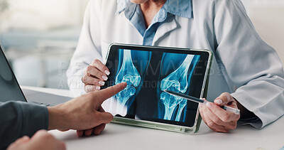 Buy stock photo Tablet screen, doctor and patient hands with xray for knee injury, surgery planning or diagnosis. Health, people and tech with CT scan review for joint dislocation, assess damage and clinic follow up