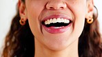 Closeup of laughing woman showing crooked teeth with orthodontic invisible braces to straighten and align. Headshot of smiling, happy and confident lady promoting healthy oral and tooth care routine