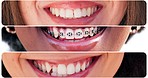 Smile, happy and closeup of mouth of women in city for happiness, joy and facial expression. Diversity, dental and collage of people with braces for teeth whitening for confidence, pride and health