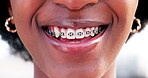 Teen, girl and mouth, teeth and braces with dental closeup, smile and health with happiness. Orthodontics, metal and healthcare with cosmetic, lips and glow, oral care and adolescent with grooming