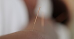 Person, closeup and body with acupuncture needle for tension, alternative medicine and physical therapy. Skin, patient and client with muscle healing for pain, stress relief and holistic treatment