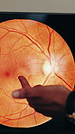 Hand, point and monitor for optometry scan at hospital with exam, retinopathy or optic nerve damage. Person, ophthalmologist and screen for analysis, veins or xray for diagnosis at eyesight clinic