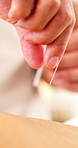 Acupuncture, back and hands with people in clinic for treatment of muscle tension or pain relief. Healthcare, medical or needle with person and therapist in wellness spa for recovery or support