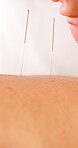 Acupuncture, back and hands of therapist with patient in clinic for muscle tension or pain relief treatment. Healthcare, medical and needle with client in spa for recovery, support or wellness
